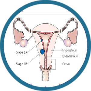 Uterine Cancer Specialist in Delhi